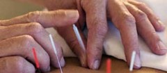 acupuntura-parelheiros-1487011335