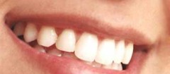 implantes-dentarios-parelheiros-1487015987